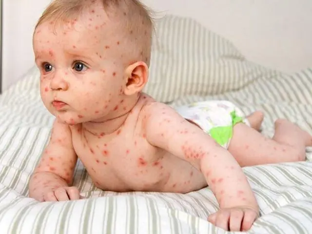 Bệnh Sởi Ở Trẻ Mầm Non: Cách Nhận Biết, Phòng Ngừa Và Chăm Sóc Bé Yêu Cha Mẹ Cần Biết